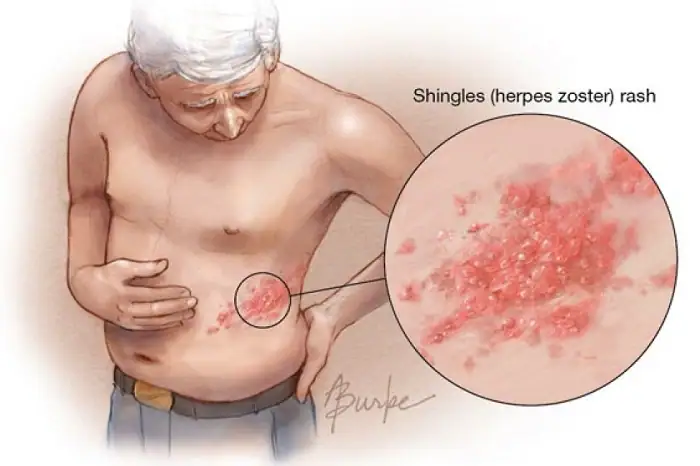 Symptoms