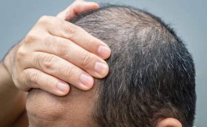 The Ultimate Guide to Hair Systems: Everything You Need to Know Screenshot 6 1